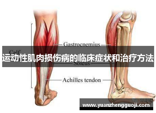 运动性肌肉损伤病的临床症状和治疗方法